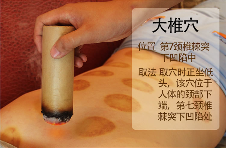 三伏灸大椎穴