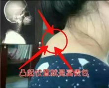 <strong>艾灸祛痰湿消减富贵包</strong>