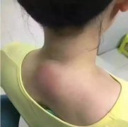 颈椎病的症状脑梗的前兆 颈椎这坨肉是堵塞