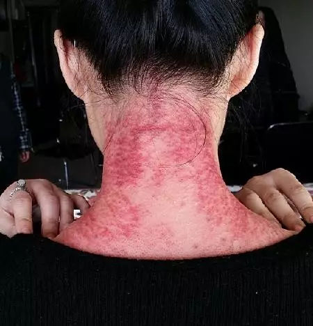 颈椎病怎么治疗