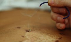 麦粒灸怎么操作