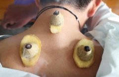 夏天艾灸正当时,艾灸疗法常用穴位