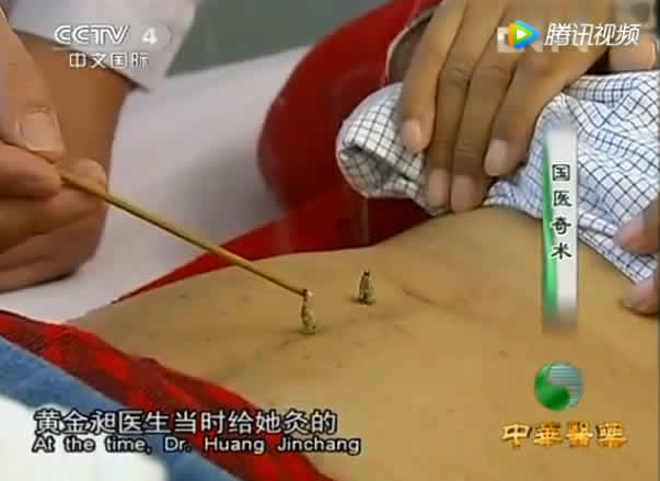 艾灸助力放化疗,太神奇了!
