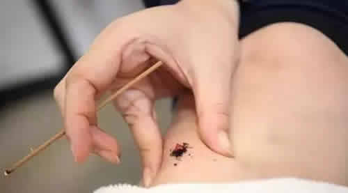 麦粒灸效果好吗?