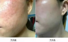 艾灸美容效果怎么样