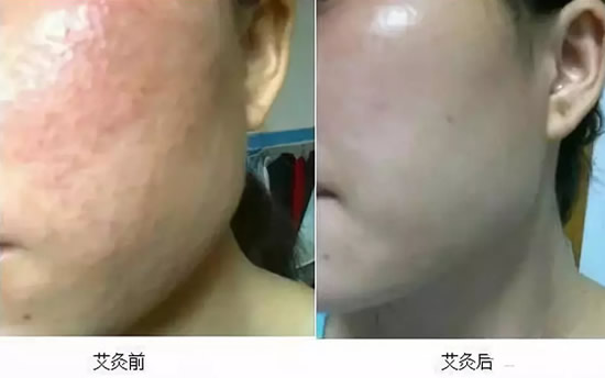 艾灸灸脸的好处