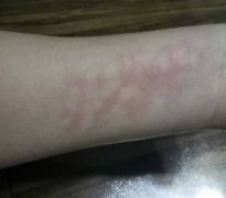 艾灸后出现白斑