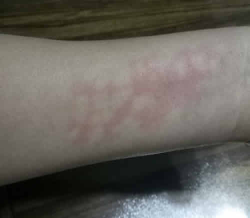 艾灸后出现白斑怎么回事 