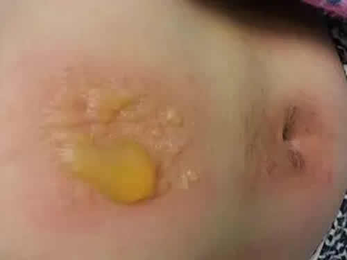 艾灸后出水泡