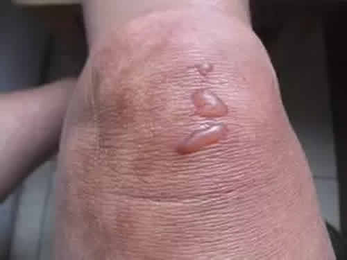艾灸后出汗