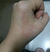 艾灸后全身起白斑