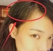 艾灸可以治疗白发吗
