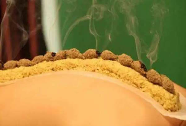 改良后的长蛇灸