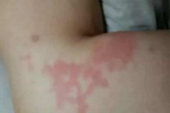 艾灸后皮肤有红印怎么办