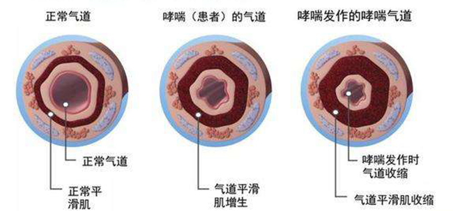 小儿哮喘如何治疗