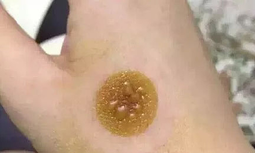 艾灸起泡怎么处理