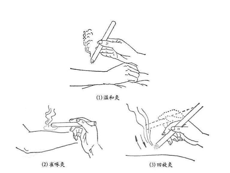 艾条悬灸