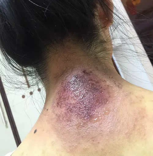 艾灸大椎穴图片