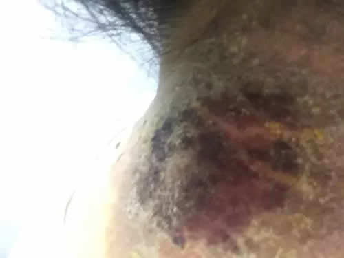 艾灸大椎穴图片