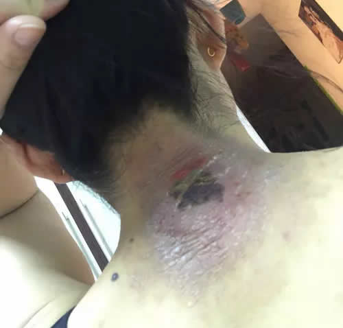 艾灸大椎穴图片