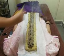 督脉灸:艾灸效果太神奇