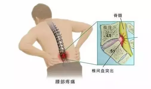 腰间盘突出的艾灸疗法