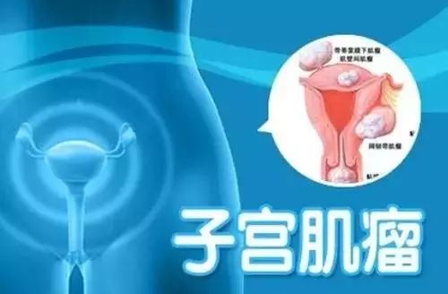 子宫肌瘤艾灸哪个部位