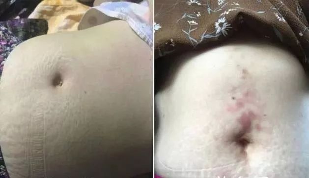 医院判死刑,艾灸捡回一条命
