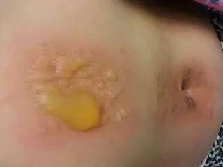艾灸出水泡要挑破吗