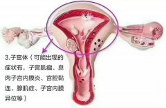 子宫肌瘤可以艾灸吗?灸什么穴位