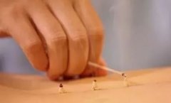 麦粒灸视频_麦粒灸操作要领
