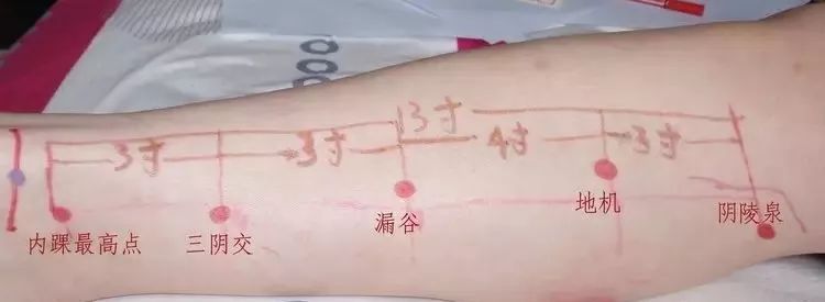痛风可以艾灸治疗吗