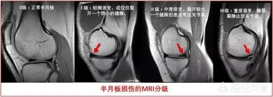 半月板损伤艾灸哪里