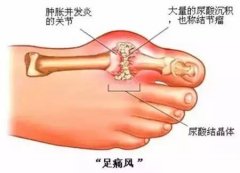 艾灸治疗痛风