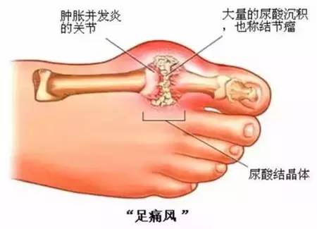 艾灸治疗痛风
