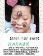 艾灸治疗鼻炎的方法用艾艾贴