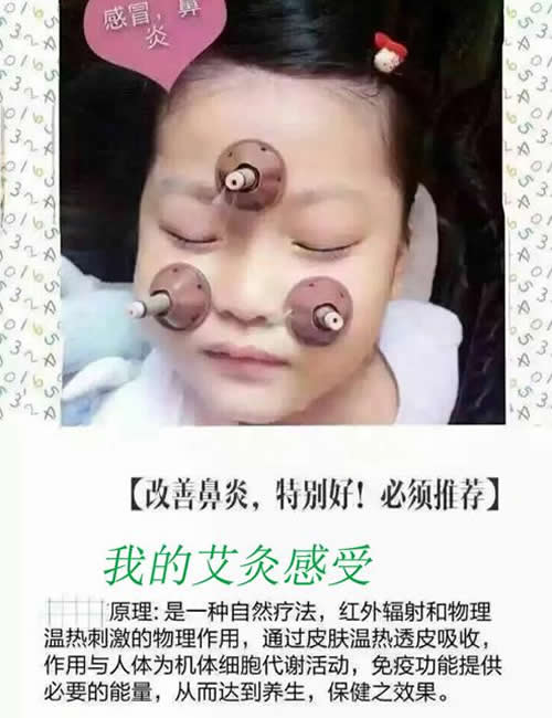 艾灸治疗鼻炎的方法