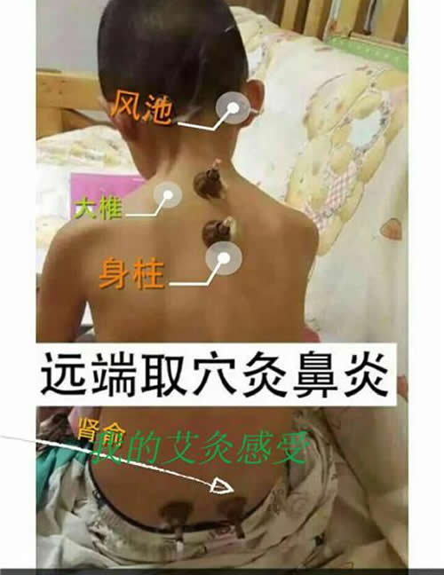 艾灸治疗鼻炎的方法