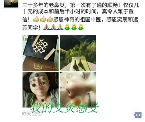 艾灸治疗鼻炎的方法