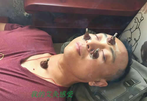 艾灸治疗鼻炎的方法