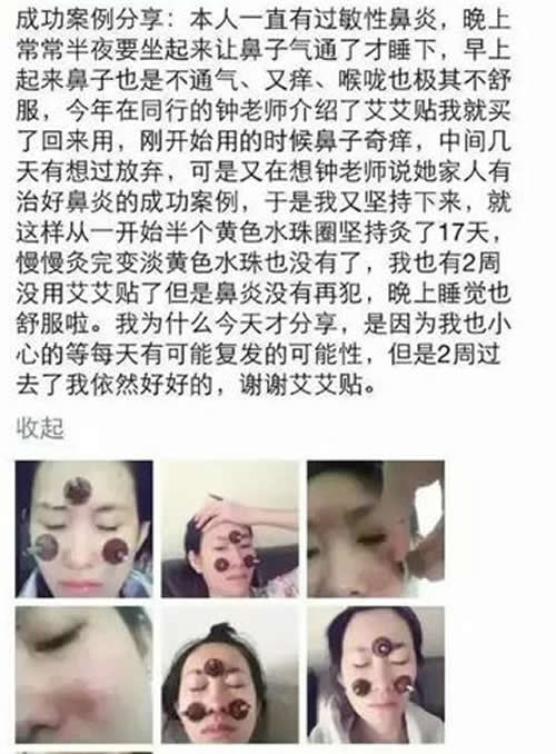 艾灸治疗鼻炎的方法