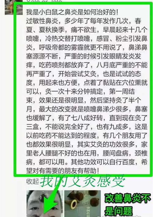 艾灸治疗鼻炎的感受
