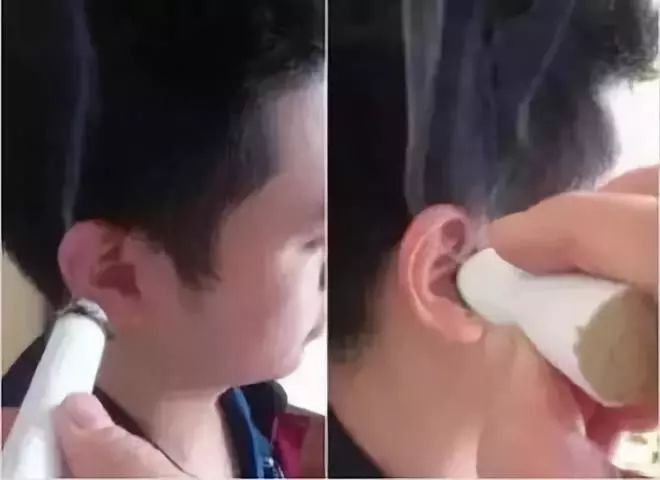 艾灸治疗耳鸣