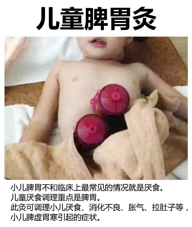 小儿艾灸