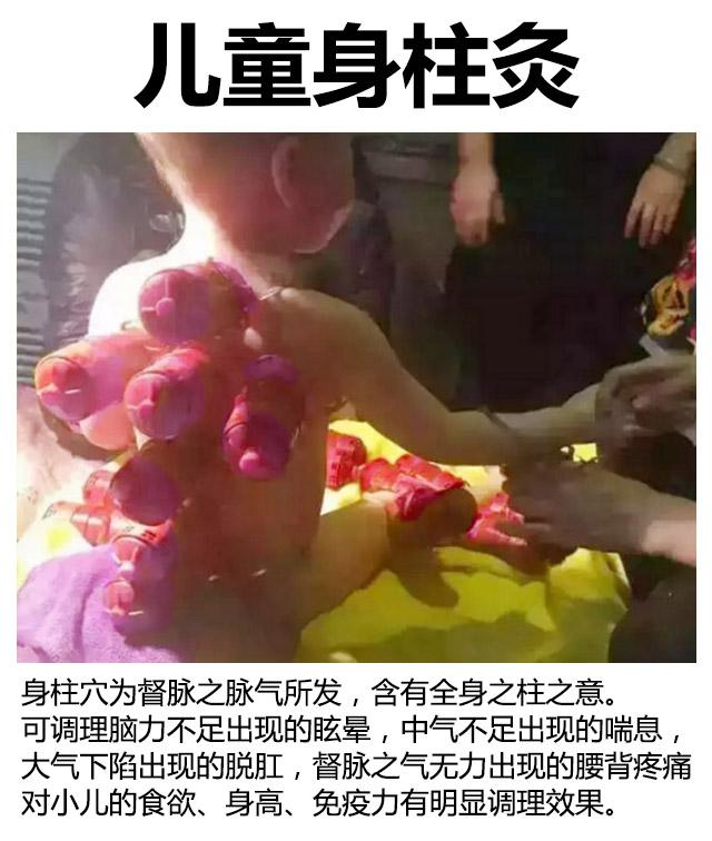 小儿艾灸