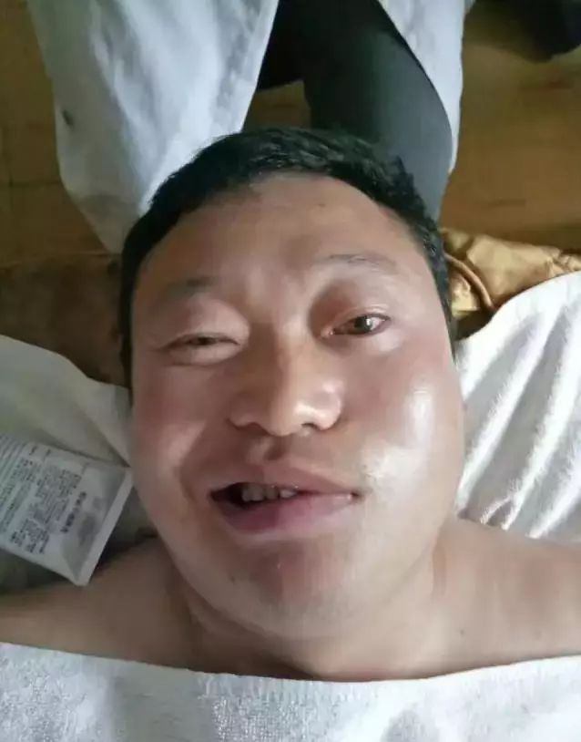 面瘫艾灸