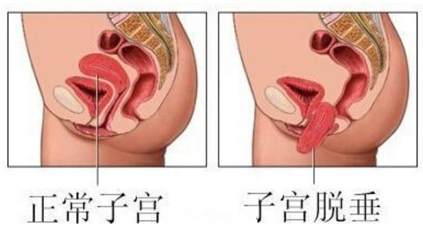 子宫脱垂的艾灸疗法
