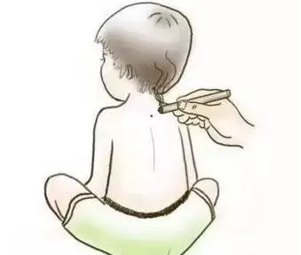 身柱灸