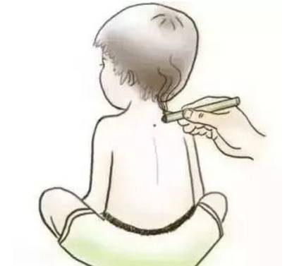 小孩子艾灸