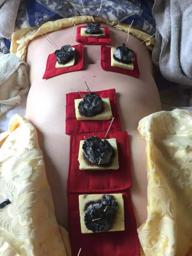 艾灸后三天死亡,施灸的15大要则